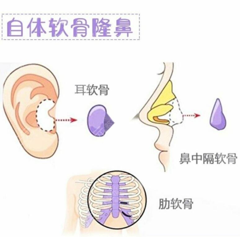 自体软骨隆鼻